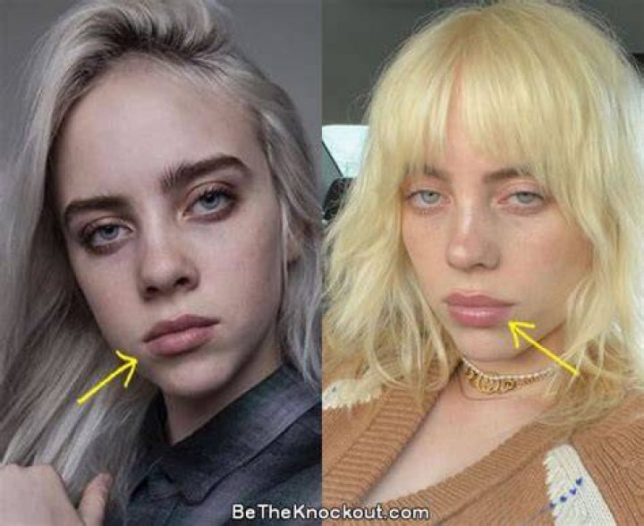 Billie Eilish Plastic Surgery. Her Boob Job Rumors
