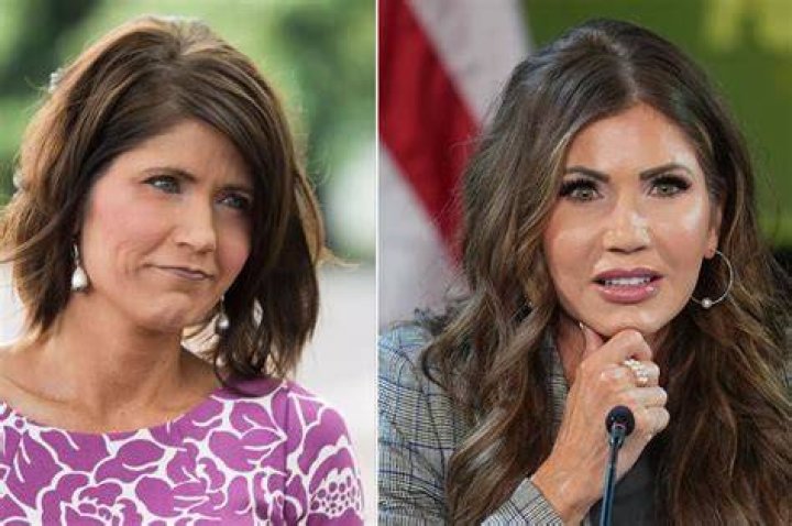 Kristi Noem’s Plastic Surgery Couldn’t Be More Obvious to Viewers in