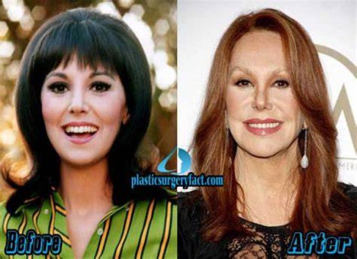 Marlo Thomas Plastic Surgery With Before And After Photos