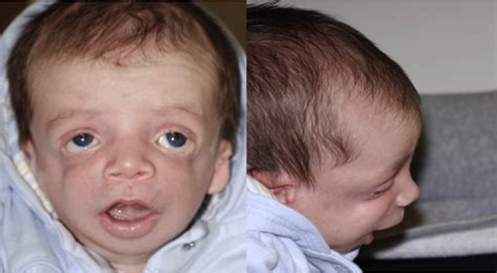 Syndrome