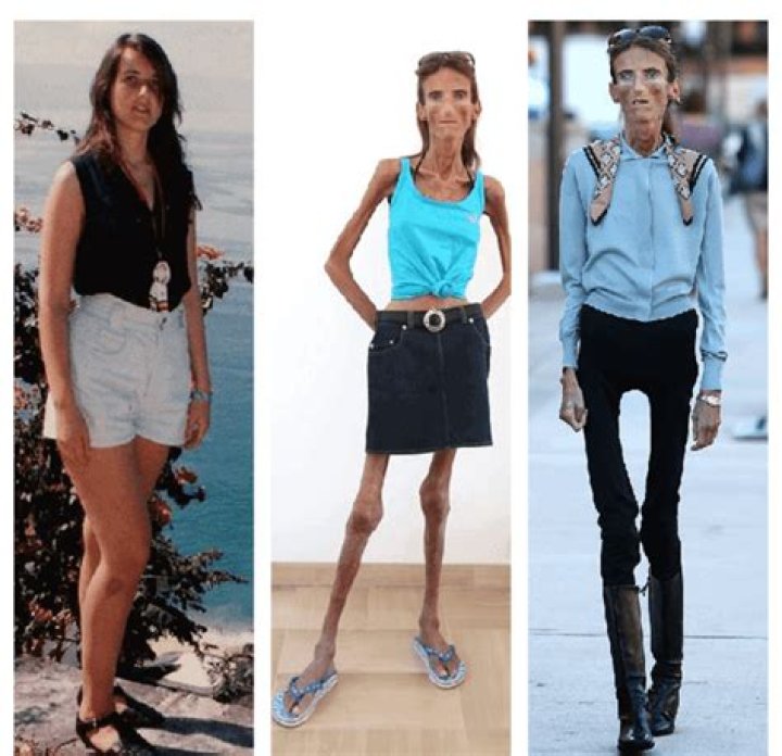 Who is the Skinniest Person in the World? Fashionterest
